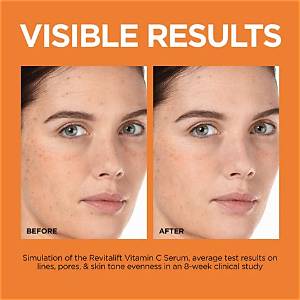 Before and After at the C Spot La: Dermatologist Insights and Treatment Results