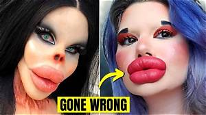 Botched Cosmetic Surgeries and the Viral 'Monsters, Inc. Lips' Phenomenon Explained