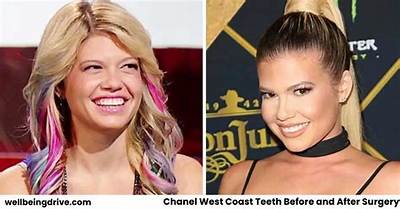Chanel West Coast Teeth Before and After 2021: Visual Evidence and Procedure Breakdown
