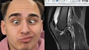 Lacy Knee Surgery Explained: Diagnosis, Stream Hiatus, and Expected Recovery Timeline