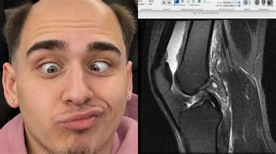 Lacy Knee Surgery Explained: Diagnosis, Stream Hiatus, and Expected Recovery Timeline