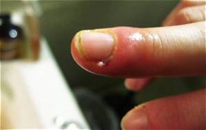 Why You Should Never Rip a Hangnail: the Hidden Danger of Sepsis and Paronychia